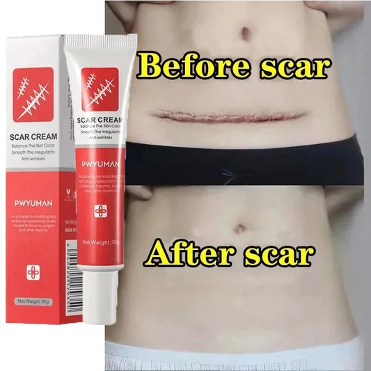 Effective Scar Removal Cream Fast Treatment Stretch Marks Burn Surgical Scars Acne Spots Repair Whitening Moisturizing Skin Care